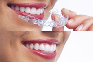 I vantaggi di applicare un apparecchio per i denti invisibile